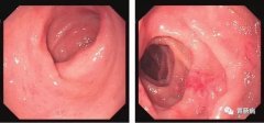 萎縮性胃炎不可怕，只要